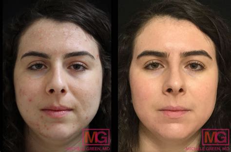 acneclinicnyc|best dermatologist for acne nyc.